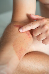 Close-up of an arm wound with applied healing ointment. Concept of first aid, wound care, and treatment of skin injuries.