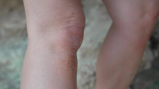 Skin knee dermatitis. Woman scratching dry, irritated skin patches caused by eczema or allergic reaction outdoors.