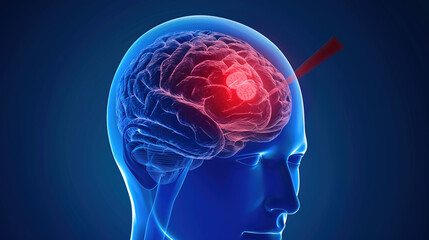 Fototapeta premium Glioma: Primary Brain Tumor Arising from Glial Cells—Types Include Astrocytoma, Oligodendroglioma & Glioblastoma, Diagnosed via MRI/CT Scans & Biopsy, Treated with Surgery, Radiation, Chemotherapy & T