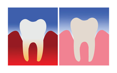Comparison of healthy and diseased gums surrounding a tooth