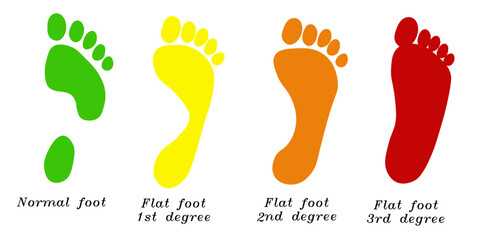 Colorful infographic showing normal foot arch and flat foot stages (1st, 2nd, 3rd degree). Medical and orthopedic vector chart for diagnostics, physiotherapy, podiatry, and pediatric foot health