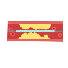 Cholesterol Buildup in Blood Vessel concept