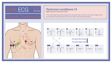 The right chest lead is to place a chest lead electrode on the right chest, which is the mirror image of the left chest lead, and is used to explore the right ventricular electrocardiogram.
