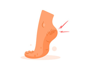 Illustration of dry, cracked or chapped feet. Cracked feet are caused by dry skin. Health problems and skin diseases. Flat design style. White background.