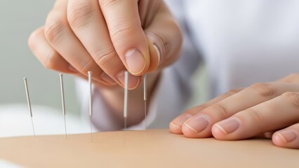 A close-up view of a medical practitioner's hand precisely inserting fine acupuncture needles into a patient's skin for holistic therapy