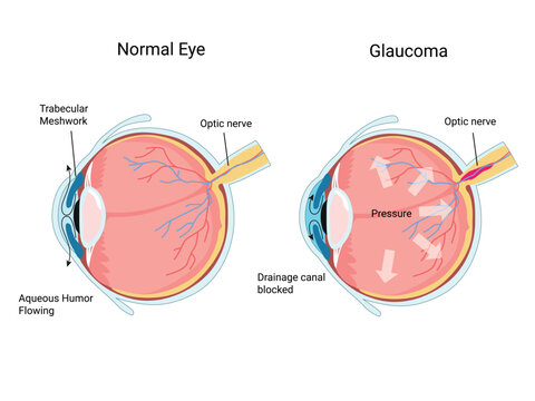 Glaucoma. Human Eye anatomy. Intraocular pressure.  Vision loss. Diagram for education and medical use.  Vector illustration
