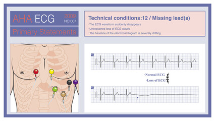 When the leads of the electrocardiogram fall off, most often in the chest leads, the ECG waves in that lead may suddenly disappear. Do not misdiagnose this as cardiac arrest.
