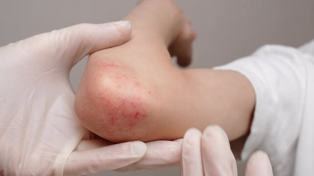Dermatologist examines reddened, itchy areas with rash on child's elbow, close-up. Child suffers from allergic reactions and dermatitis. Concept of pediatric dermatological skin diseases and treatment