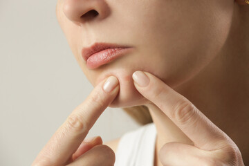 Young woman with a pimple on a chin. Inflamed acne and post-acne marks, redness. Hormonal adult...