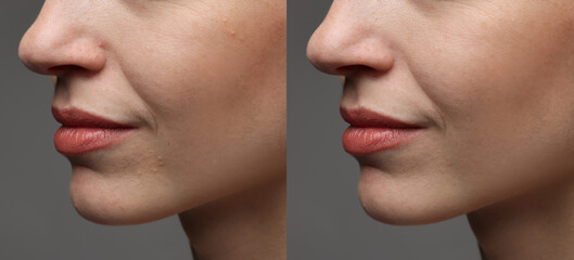 Woman showing her skin before and after cosmetic treatment, closeup. Collage on grey background
