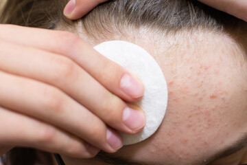 Forehead skin cleansing with cotton pad removing acne