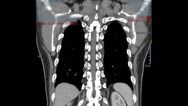 Chest CT scan of a male patient showing the spread of thymus cancer, the cause of Myasthenia Gravis.