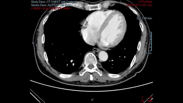 Chest CT scan of a male patient showing the spread of thymus cancer, the cause of Myasthenia Gravis.