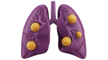 Human lungs with tumors PNG isolated on transparent background, lung cancer concept for medical and healthcare designs, anatomical organ