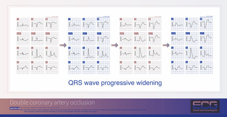 A patient with acute inferior and anterior myocardial infarction(MI) caused by distal occlusion of the RCA  and one day later, combined with occlusion of the LAD, caused high lateral and anterior MI.
