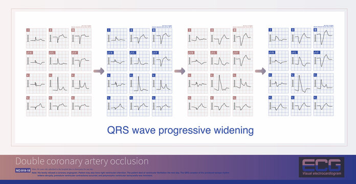 A patient with acute inferior and anterior myocardial infarction(MI) caused by distal occlusion of the RCA  and one day later, combined with occlusion of the LAD, caused high lateral and anterior MI.
