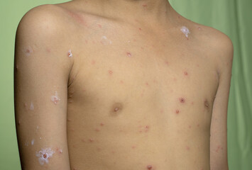 close up of smallpox on the front of a boy's body