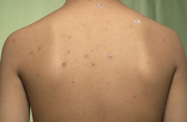 portrait of a boy suffering from smallpox on the back of his body