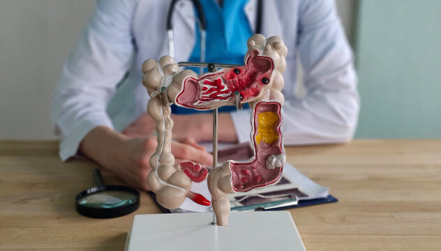 Medical model shows human colon structure during a consultation in a healthcare