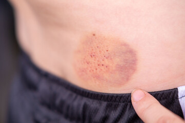 Fototapeta premium little boy holds sore side, human skin with large red and prominent purple bruise, lower back or hip area, showing discoloration from injury, Medical condition, childhood safety