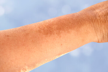 Close-up mature woman&rsquo;s hand with age spots and pigmentation, showing signs of melanin overproduction, aging skin, and natural changes, skincare and health concept, hyperpigmentation