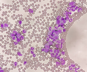 Chronic myeloid leukemia cells or CML, analyze by microscope