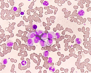 Chronic myeloid leukemia cells or CML, analyze by microscope