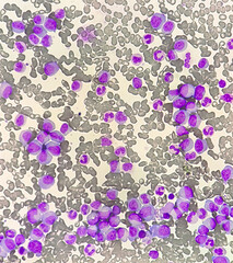 Chronic myeloid leukemia cells or CML, analyze by microscope
