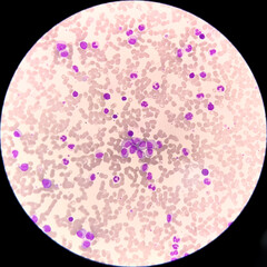 Chronic myeloid leukemia cells or CML, analyze by microscope