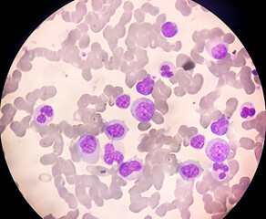 Chronic myeloid leukemia cells or CML, analyze by microscope
