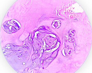 PhotoMicrograph of histological slide:
Specimen: Tissue from L4-5 disc space,
Microscopic Exam: Degenerative fibrocartilage,
Diagnosis: Compatible with intervertebral disc.