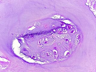PhotoMicrograph of histological slide:
Specimen: Tissue from L4-5 disc space,
Microscopic Exam: Degenerative fibrocartilage,
Diagnosis: Compatible with intervertebral disc.