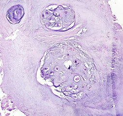 PhotoMicrograph of histological slide:
Specimen: Tissue from L4-5 disc space,
Microscopic Exam: Degenerative fibrocartilage,
Diagnosis: Compatible with intervertebral disc.