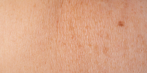 Skin mole spot closeup. Human birthmark, nevus macro texture
