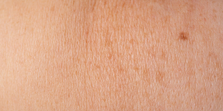 Skin mole spot closeup. Human birthmark, nevus macro texture