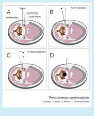 When malignant tumors infiltrate the cervical spine, the vertebral body is damaged and can be reconstructed through percutaneous injection of bone cement.
