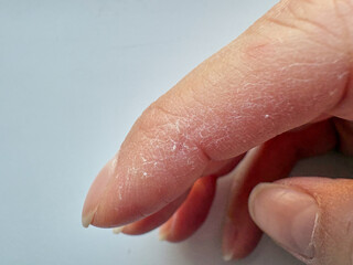 Damaged skin on the hands. Cracked skin on the hands. Eczema on the hand.