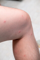 Close-up of spotted skin marks after playing in the sea during rainy season, natural outdoor effects