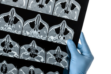 Hand in blue medical glove holds at CT examination of the paranasal sinuses xray film contrast image