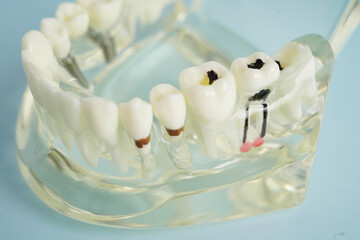 Dental teeth model on white background for learn about dentistry.