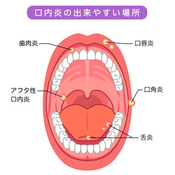 口内炎の出来やすい場所　口の中　医療