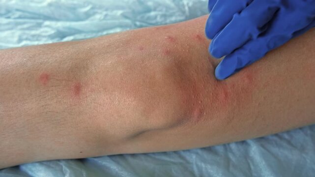 Doctor examining teen girl with bodily red rash. Allergy closeup. Teenager scratches eruption. Nurse applies special cream to atopic skin. Dermatitis, irritation, hive. Pruritus. Mosquito, flea bites