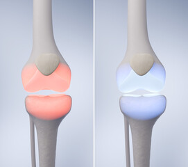 Before and after knee pain treatment comparison showing red injury and blue healthy joint. 3D rendering