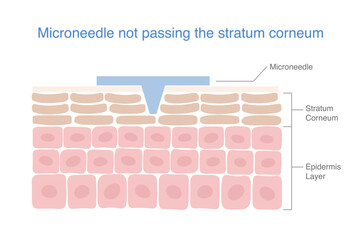 Microneedle insert into layer skin structure passed to Stratum Corneum  before epidermis. Medical nano needle for maintaining the penetration of the beauty ingredients for Smooth skin, anti aging.