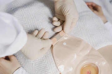 An adult nurse changes a patient's colostomy bag.