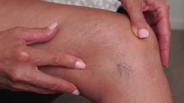 Close-up of a woman pointing at varicose veins on her leg during a dermatology examination. Useful for medical education, vascular health topics, skincare issues and vein treatment visuals.