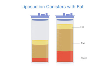 Liposuction canister that has fat, fluid and oil containing inside. Liquid suction from patient's body in beauty clinic. Plastic tube with measurement and blue lid.