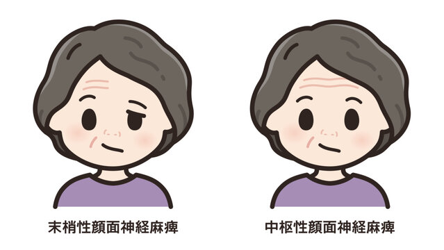 左顔面神経麻痺のイラスト_末梢性と中枢性の比較