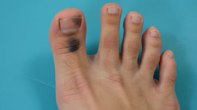 Close-up of a human foot's toes with a bruised toenail and surrounding skin against a blue background