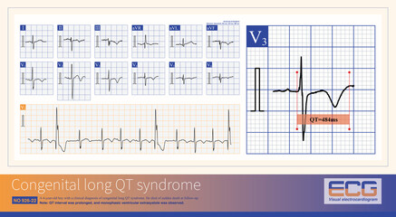 Patients with congenital long QT syndrome are at risk of developing complex ventricular premature contractions, paroxysmal ventricular tachycardia, torsades de Pointes, and ventricular fibrillation.
